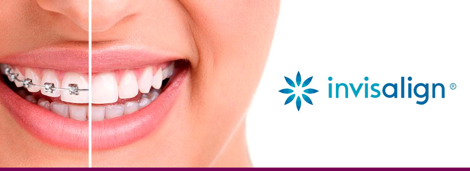 Ortodoncia-Invisible-Invisalign-Sabadell