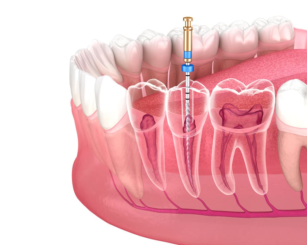 ¿De qué manera se realiza la endodoncia?