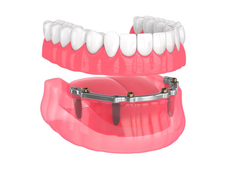 Tipos de prótesis dentales