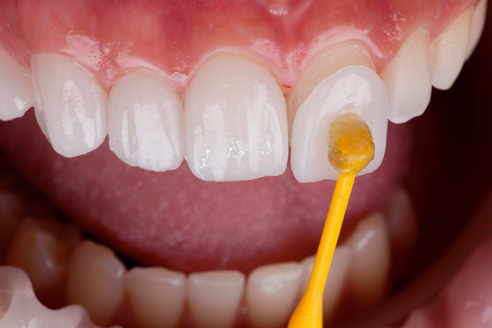 Razones para usar carillas dentales