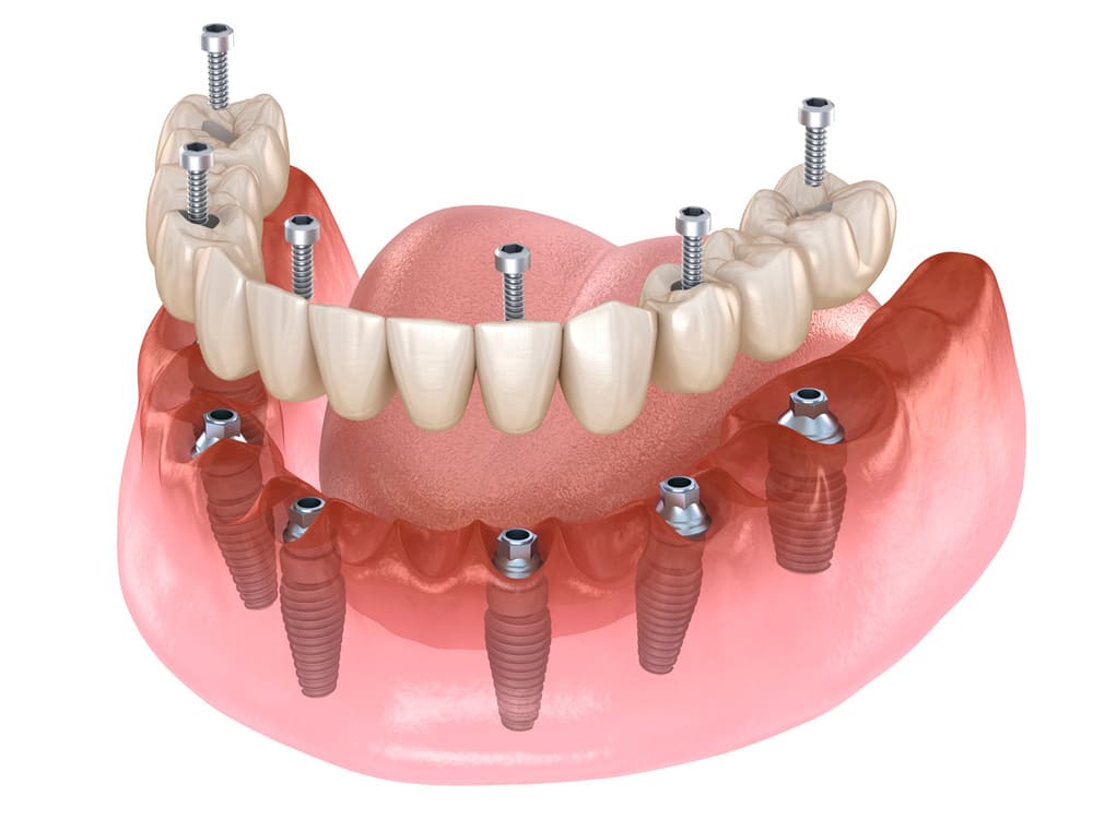 Tipos de prótesis dentales