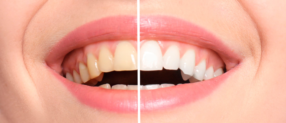 Blanqueamiento dental