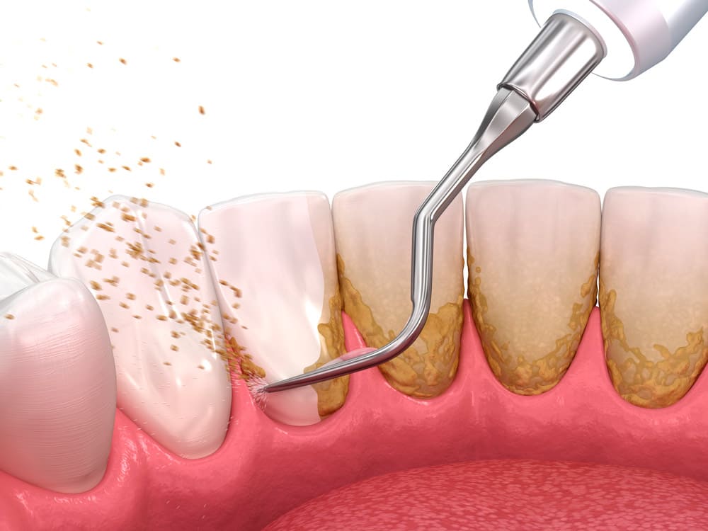 ¿Cada cuánto es conveniente realizarse una limpieza dental profesional?