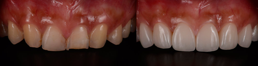 Clases de blanqueamiento dental