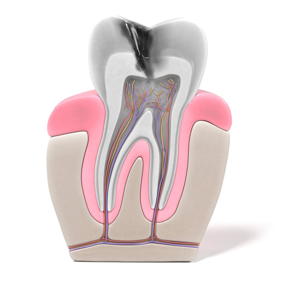 ¿Qué es la endodoncia?