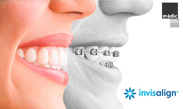 invisalign