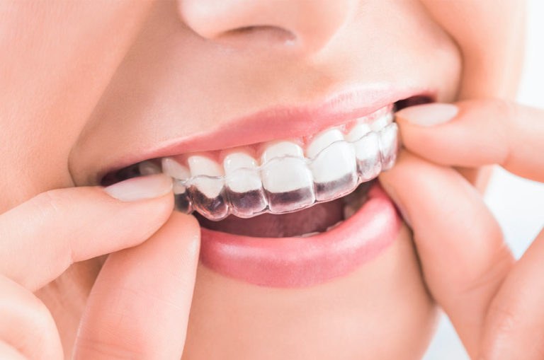 A qui es recomana Invisalign®?​