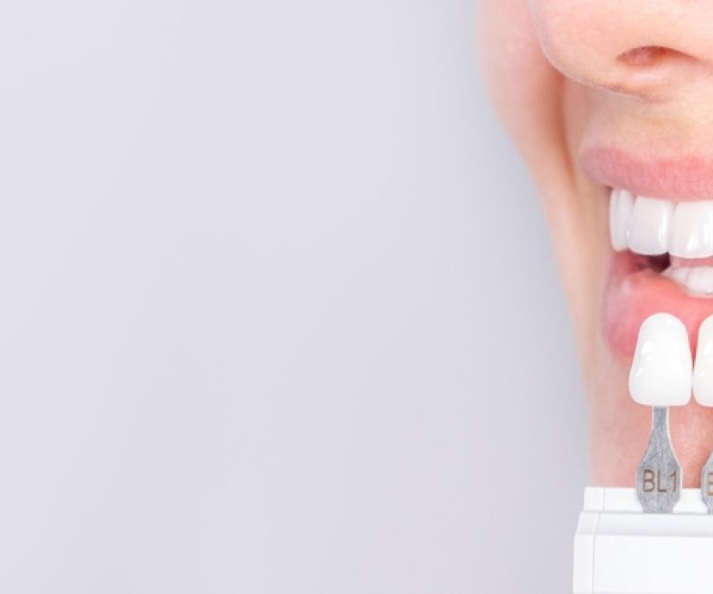 Estética Dental