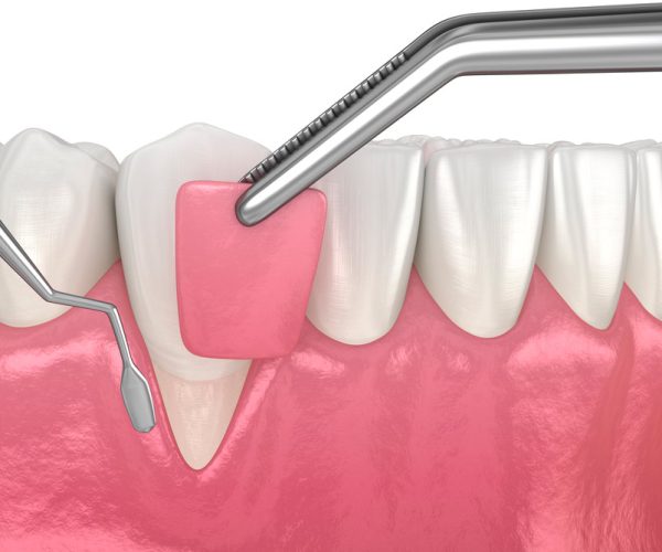 ¿En qué consiste la periodoncia?